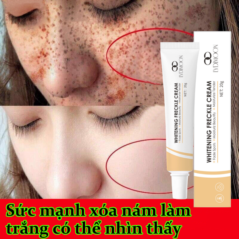 Kem Xoá Nám Nám Tàn Nhang Tinh chất làm trắng sạch tàn nhang Kem trắng da và xóa tàn nhang Kem xóa tàn nhang đồi mồi Hiệu quả làm mờ thâm nám tàn nhan kem thâm nám tàn nhang đồi mồi Dưỡng Ẩm Làm Trắng Da