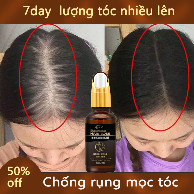 Tinh chất Mọc Tóc Herbal Hair, Kích Thích Mọc Tóc Nhanh Chóng, Giảm Rụng Tóc, Nuôi Dưỡng Tóc Bồng Bềnh, Suôn Mượt Tự Nhiên kích mọc tóc nhanh Tinh dầu ngăn ngừa rụng tóc chai tinh dầutinh gừng tươi mọc tóc30ml