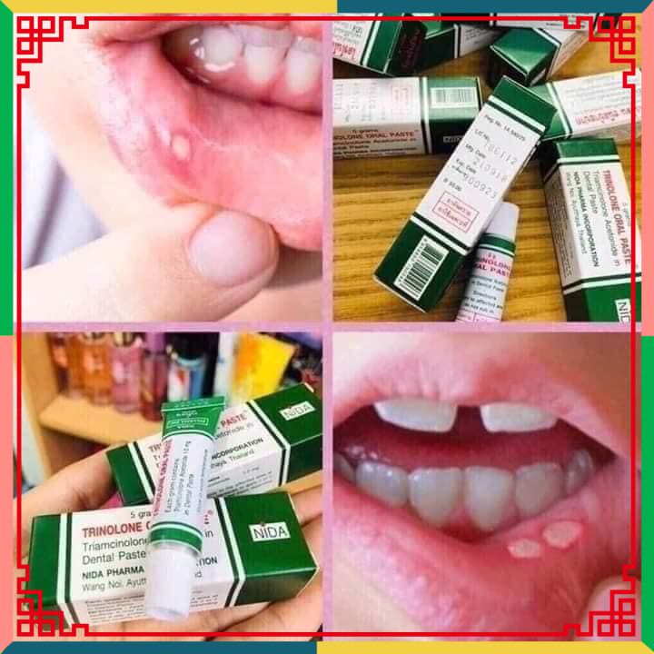 Kem Bôi Nhiệt Miệng Trinolone Oral Paste Thái Lan