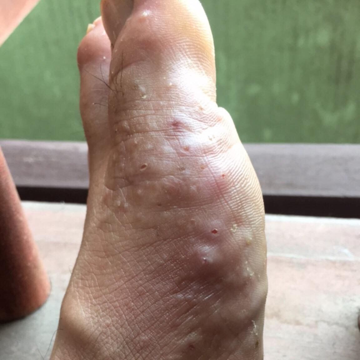 Bôi Chàm Eczema Đánh Bay Tổ Đỉa Ghẻ Nước Bôi Chàm Ngứa Mụn Bóng Nước Rất Ngứa Cải Thiện Vấn Đề Da Liễu Nấm Tổ Đỉa Chàm