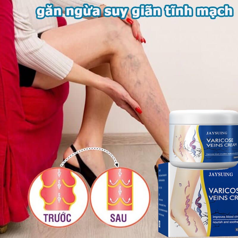 Kem bôi suy giãn tĩnh mạch 50g - Kem bôi tinh mạch
