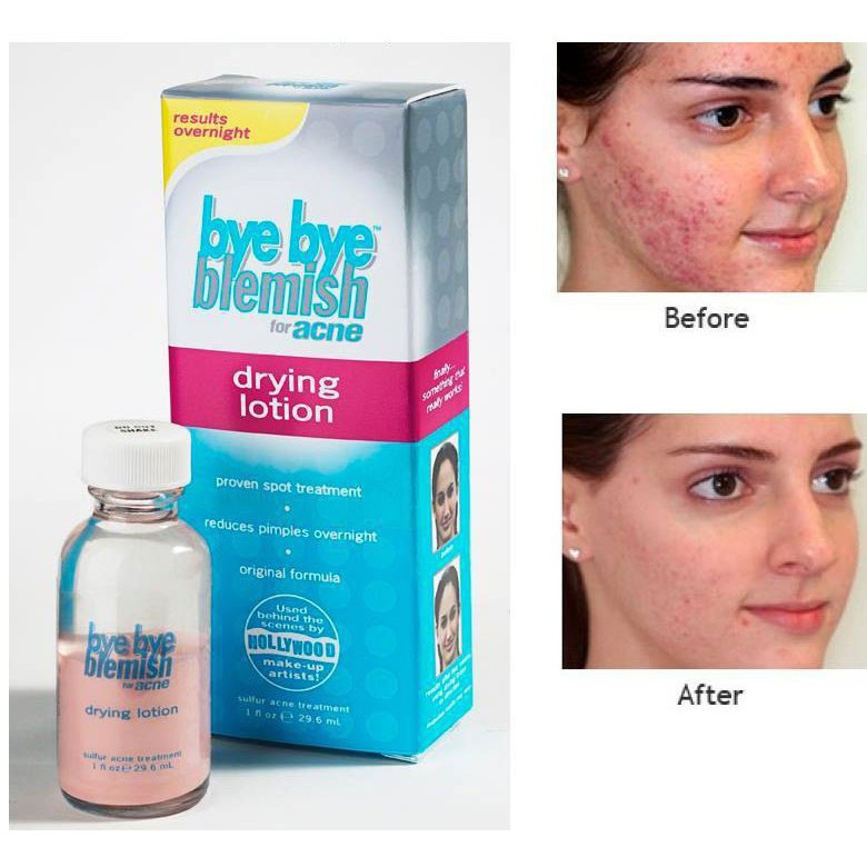 [HCM]Bye Bye Blemish For Acne Drying Lotion Giảm Mụn