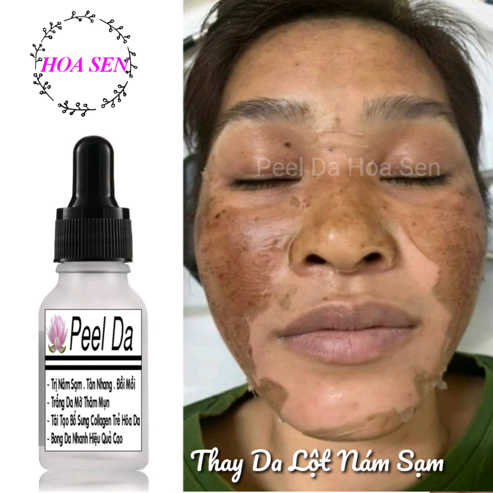[HCM]Peel Thay Da Sinh Học Hết Nám Tàn Nhang Đồi Mồi Hoa Sen