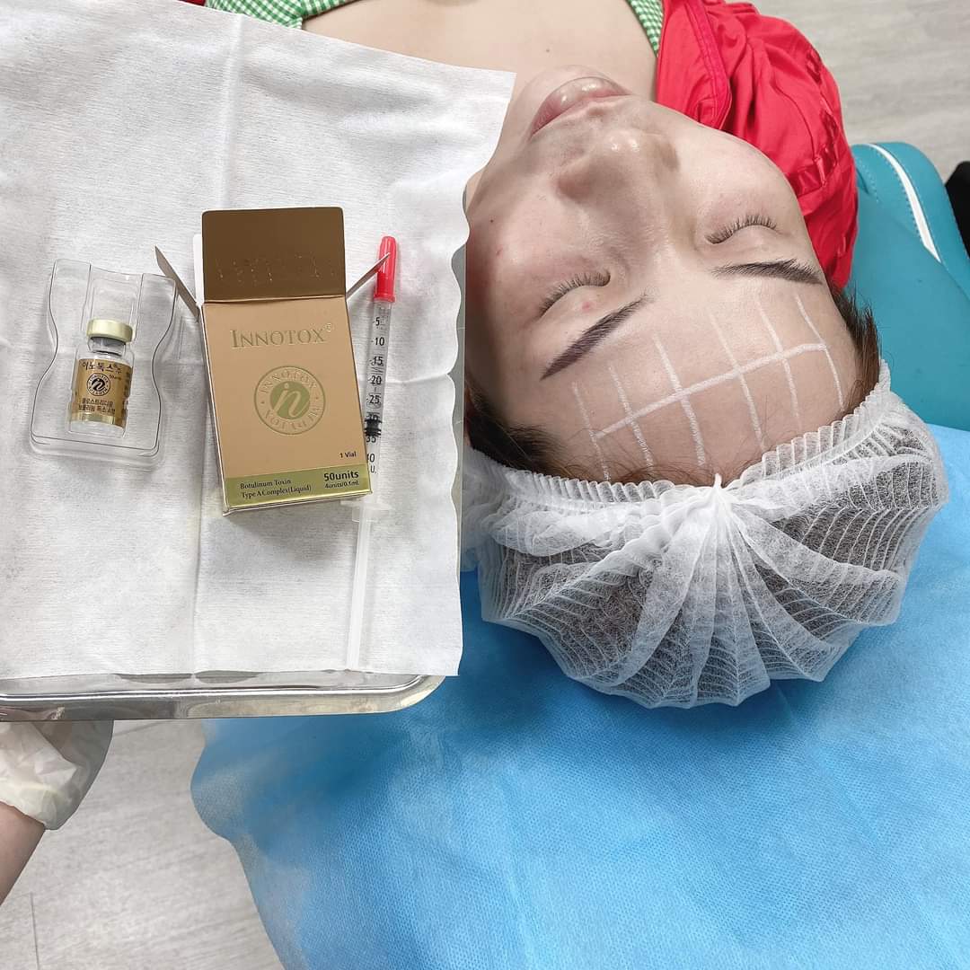 BOTOX INNOTOX 50 TIÊM CĂNG TRÁN CỰC ĐẸP ??