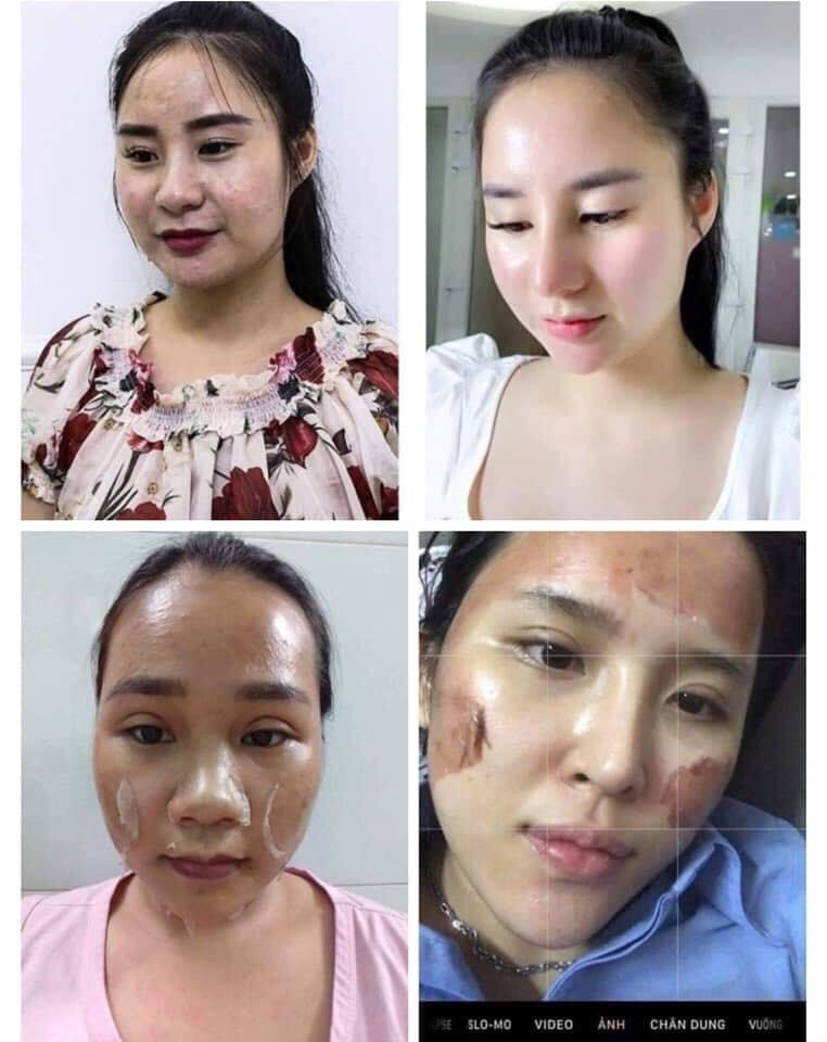 Peel da TCA 50% Đặc Trị Sẹo Rỗ, đánh bay Mụn, Hết thâm, nám, lỗ chân lông to, da dầu, rạn, sẹo lồi, Làm Hồng Ti, Hết Thâm Bẹn Nách, làm trắng mịn da