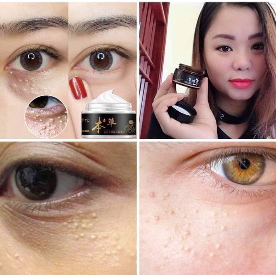 Kem Xóa Mụn Thịt Mắt Giảm Thâm Hết Bọng Mắt