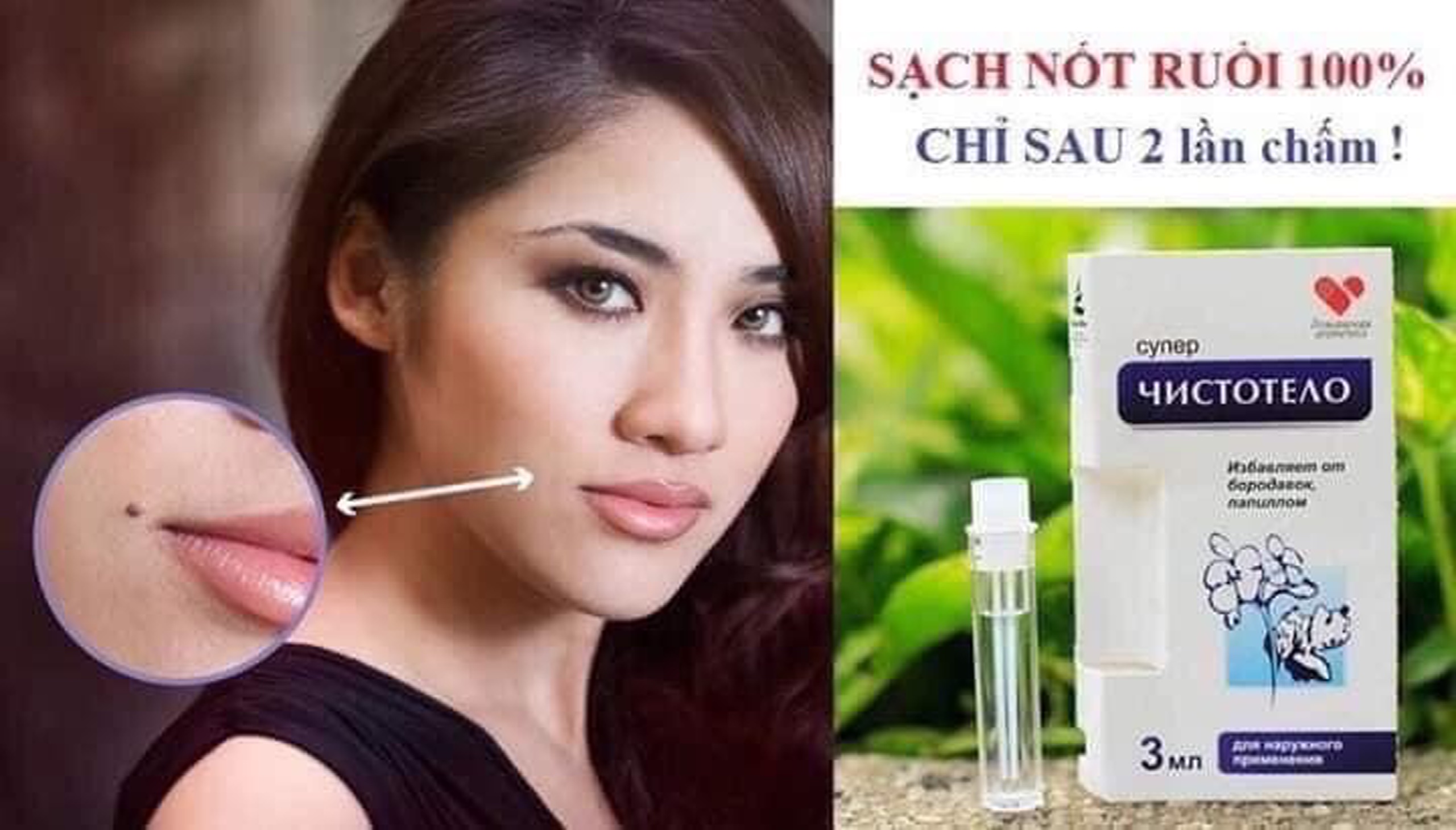 Gel tẩy nốt ruồi mụn cóc mụn thịt mụn cơm mụn ruồi Nga