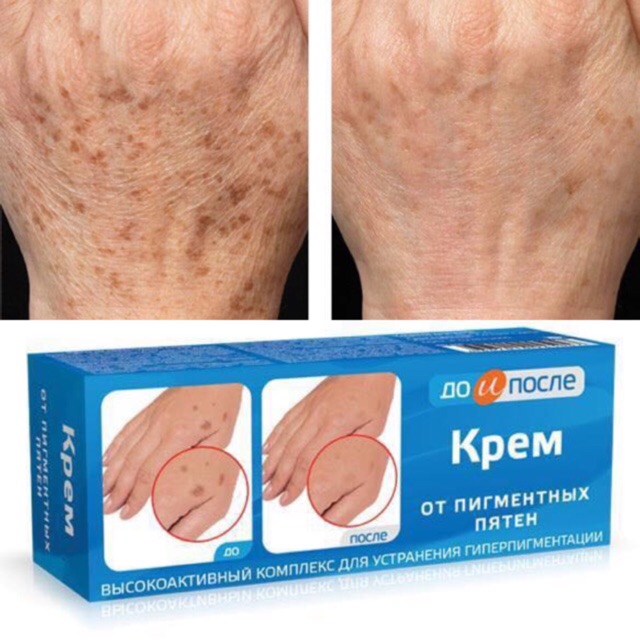 [HCM]Kem Loại Bỏ Đồi Mồi Da Tay Nga Kpem 50ml