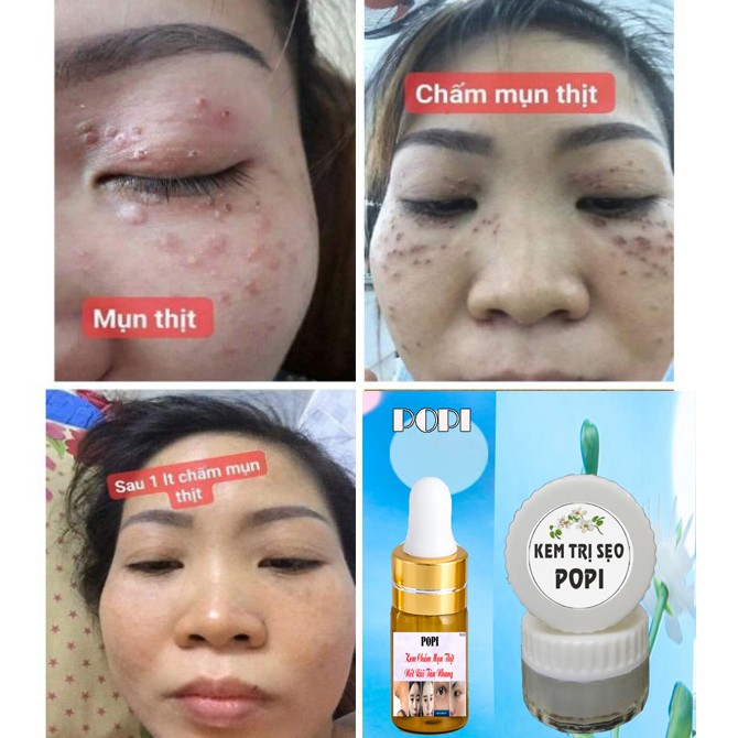 [HCM]Combo Kem Đốt Nốt Ruồi Tàn Nhang Mụn Thịt + Kem Chống Sẹo Sau Đốt Nốt Ruồi