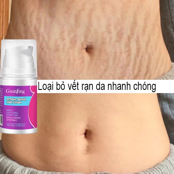Kem rạn da kem xóa rạn da cho bà bầu Kem xoá rạn da sau sinh làm mờ vết thâm tăng độ đàn hồi cho da làm trắng