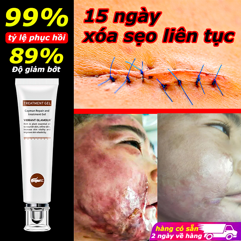 Loại bỏ sẹo cũ 40 năm、mờ sẹo、3 ngày thấy hiệu quả、cả nam và nữ、kem mờ sẹo、Vết sẹo、sẹo phẫu thuật、chăm sóc sẹo、Kem làm mờ sẹo、Kem xóa sẹo、Kem ngừa sẹo、xóa sẹo