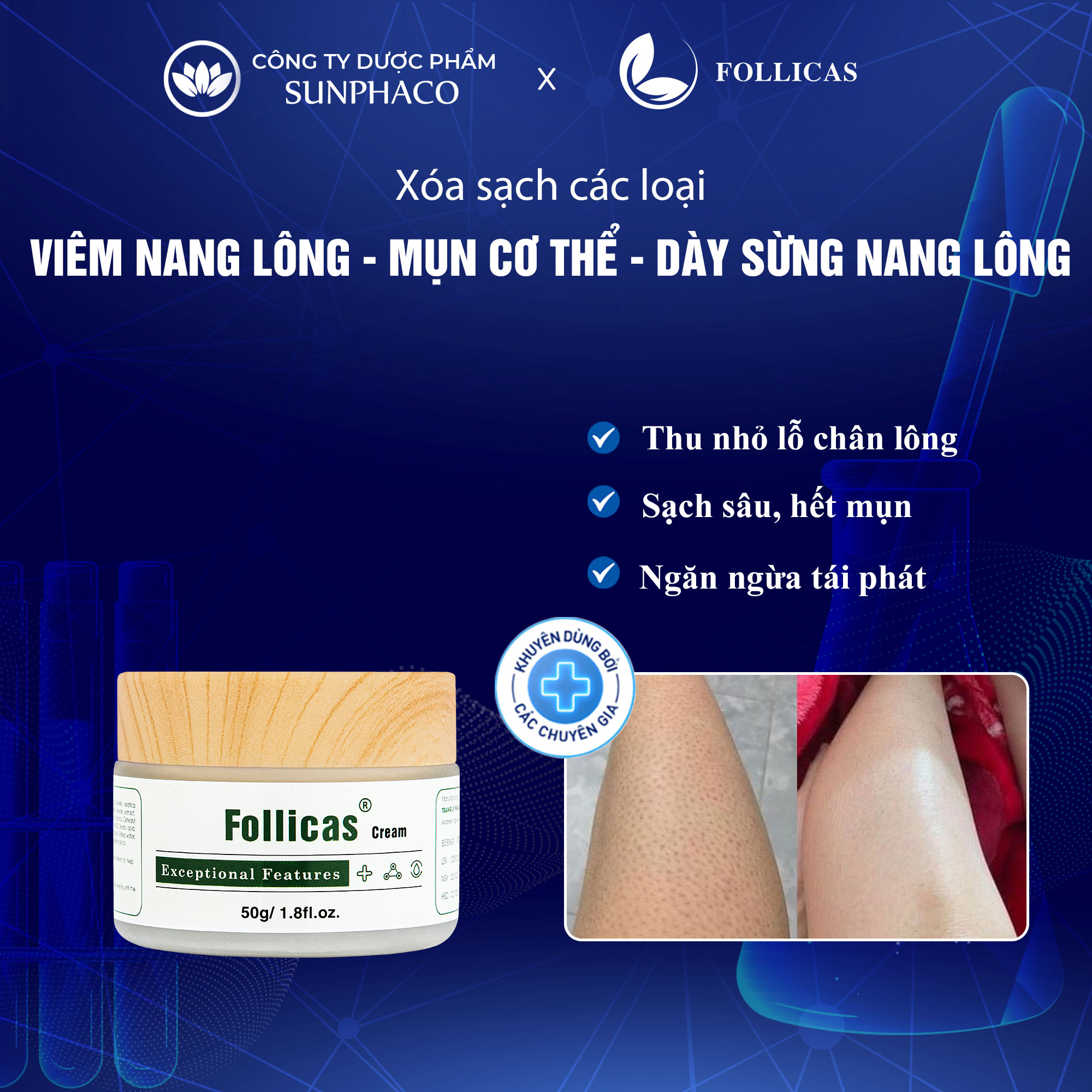 Kem viêm nang lông, mụn lưng follicas 50g giảm mụn lưng, viêm lỗ chân lông, mờ thâm giúp sáng da mịn màng