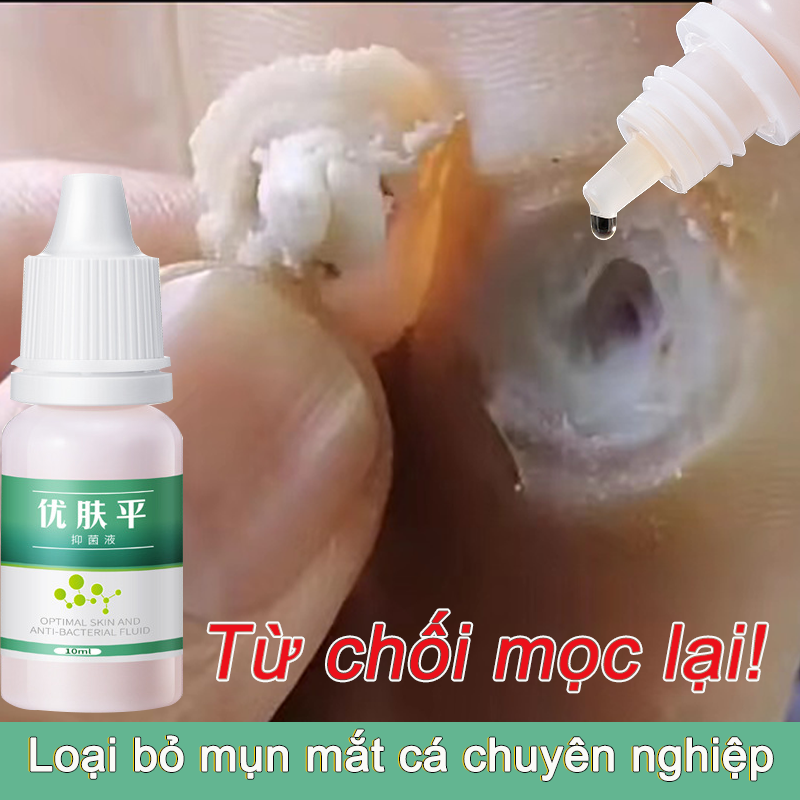 Loại bỏ hoàn toàn các loại mụn cứng đầu như mụn cóc,mụn ruồi,mụn thịt,mụn cơm lâu năm và các mụn khác.,đặc biệt là mụn thịt quanh mắt và mụn trâu,mụn cơm ,mụn thịt ở lưng và cổ,ngón chân,ntay