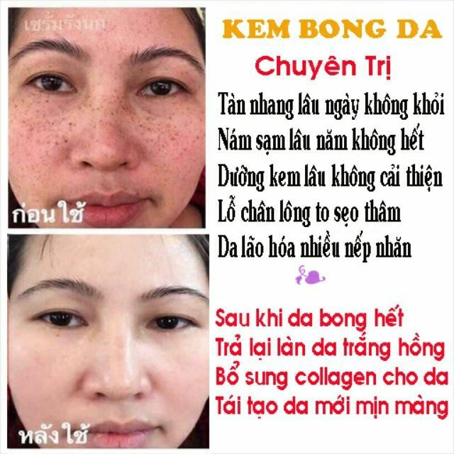Kem kích bong da thailan