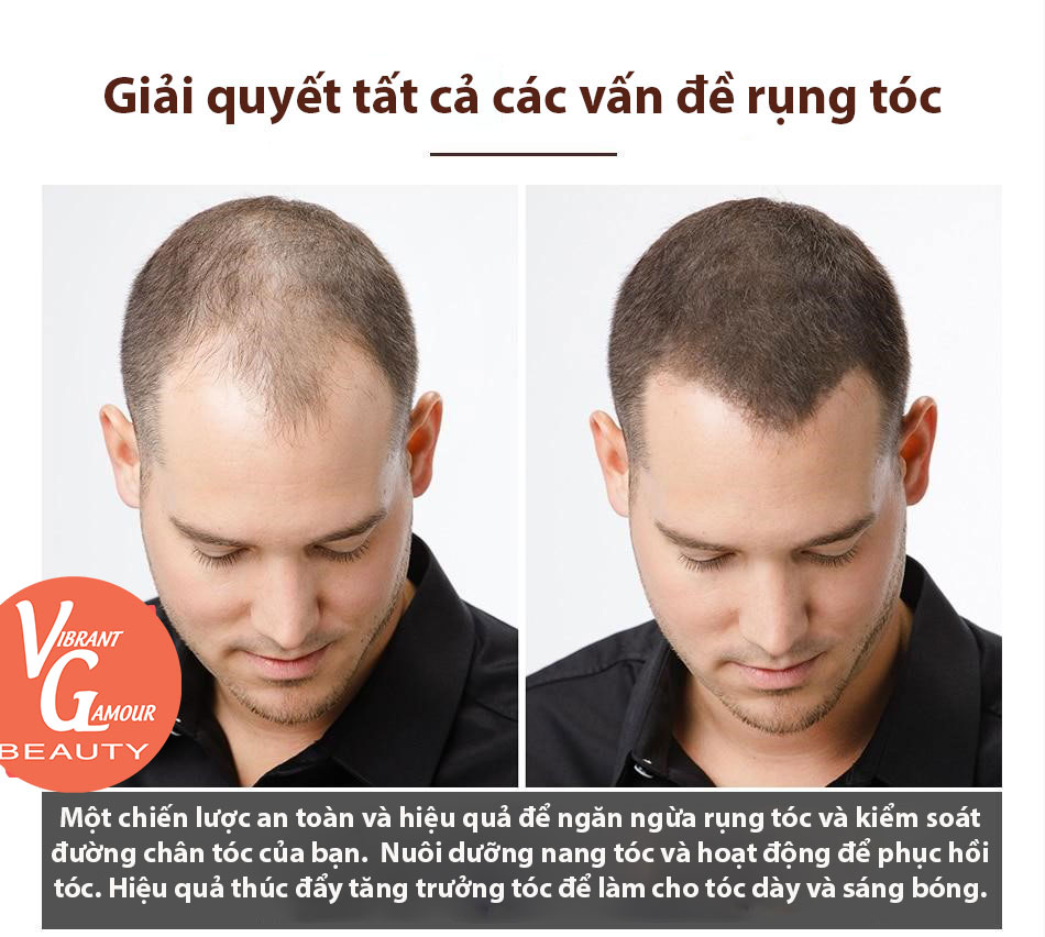 Rụng tóc ở nam giới và các phương pháp điều trị cụ thể