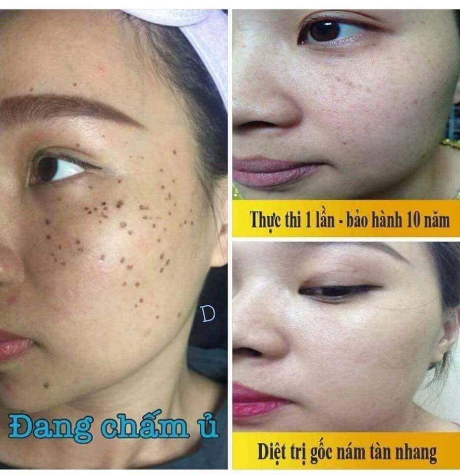 Chấm nám tàn nhang, nám chân sâu