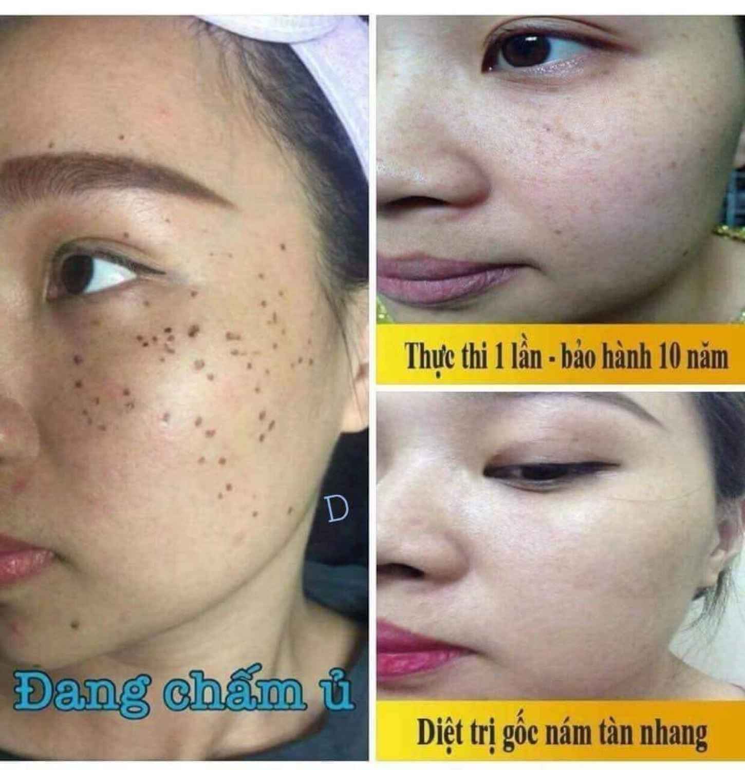 Chấm na'm tàn nhang, na'm chân sâu