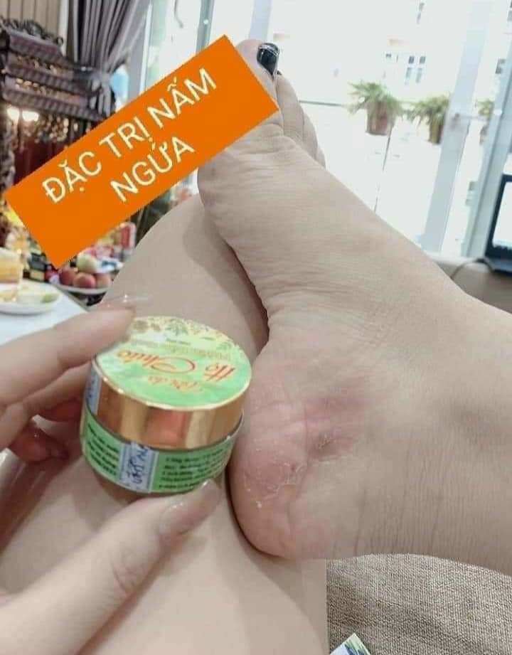Kem bôi da Họ chúc dùng cho vẩy nến, á sừng, viêm da dị ứng, nấm đầu, mề đay, chân tay đóng vảy bong tróc nứt nẻ