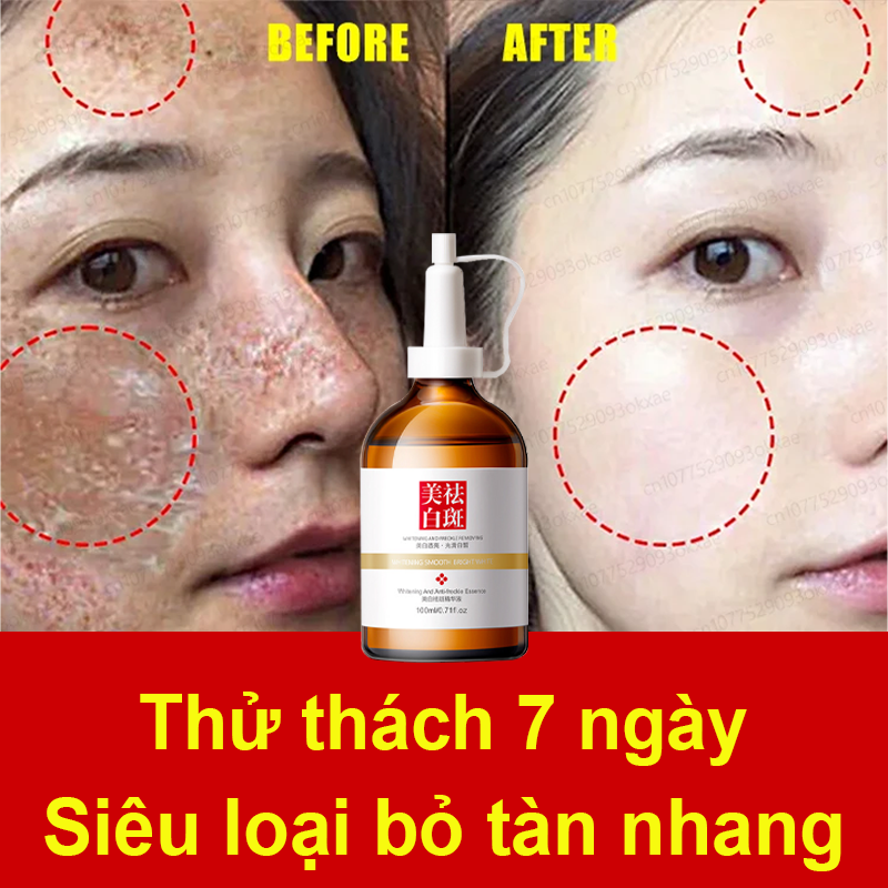 Kem xóa tàn nhang đồi mồi Kem trắng da và xóa tàn nhang Tinh chất làm trắng sạch tàn nhang 100ml Hiệu quả làm mờ thâm nám tàn nhan kem thâm nám tàn nhang đồi mồi Loại bỏ nám tự nhiên