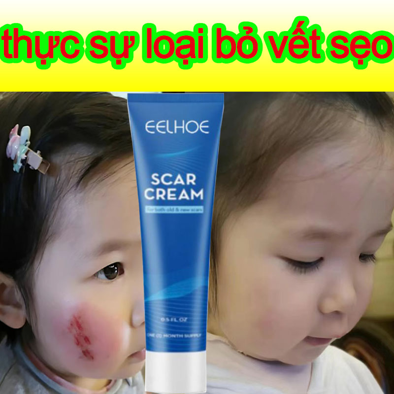 Kem mờ sẹo 45g, liền sẹo rỗ, sẹo lồi, sẹo lõm, sẹo sau tai nạn, sẹo bỏng Mờ sẹo lõm, sẹo lâu năm Hỗ trợ xử lý hiệu quả sẹo lồi, sẹo bỏng và sẹo thâm do mụn để lại Gel giảm mụn trứng cá, ngừa thâm, mờ sẹo, dưỡng da trắng sáng