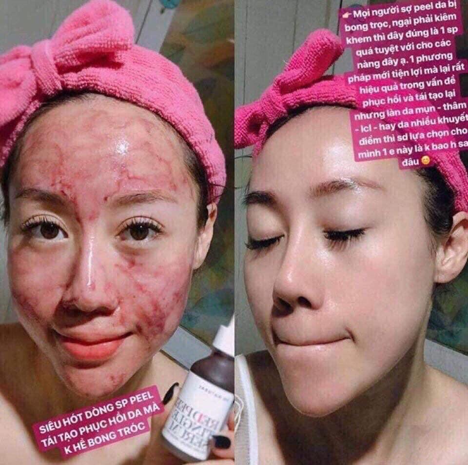 Tinh Chất Thay Da Sinh Học So’Natural Red Peel Tingle Serum