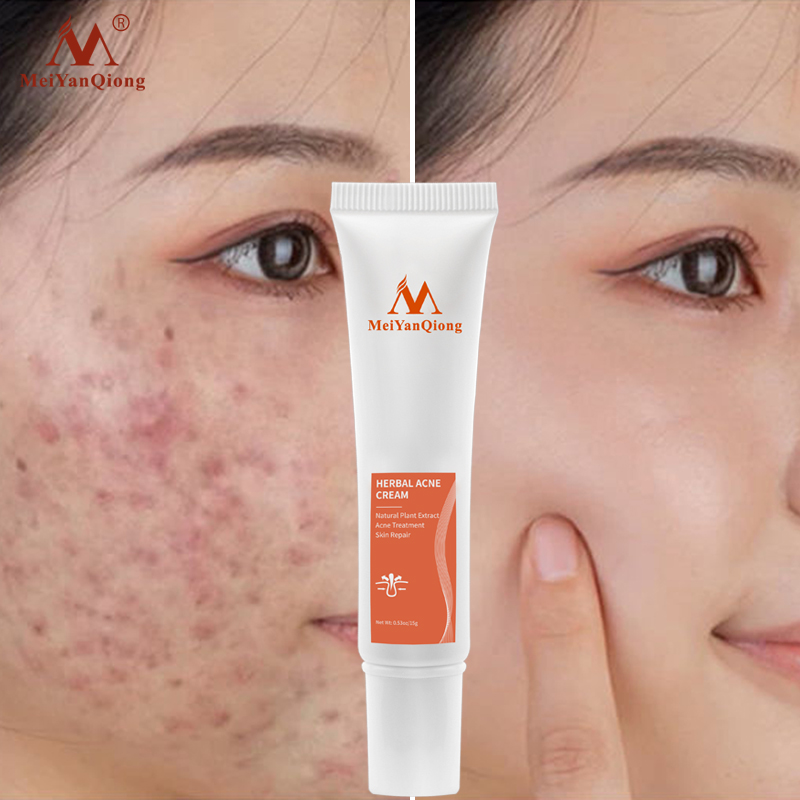 MeiYanQiong Gel mụn 15g chiết xuất thảo dược loại bỏ sẹo mụn chăm sóc da mặt - INTL