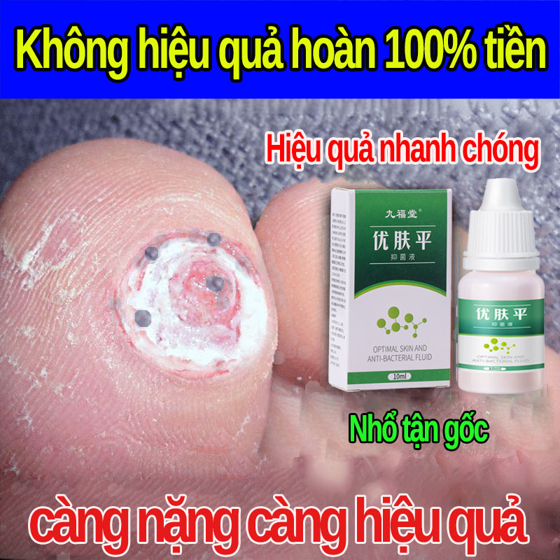 Dung dịch tẩy mụn cóc mụn cơm nốt ruồi loại bỏ tận gốc mụn cóc mụn cơm mụn thịt nốt ruồi. 100% hàng chính hãng,CHÍNH HÃNG Gel Tẩy Nốt Ruồi Mụn Cơm Mụn Cóc Mụn Thịt Tẩy Nốt Ruồi Mắt Cá Kem tẩy xoá nốt ruồi hiệu quả sau 3 - 5 ngày