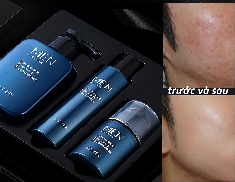 BỘ CHĂM SÓC DA MẶT CHO NAM GIỚI HẾT SẠCH MỤN KIỀM DẦU DƯỠNG ẨM CHO LÀN DA TRẮNG MƯỚT MEN