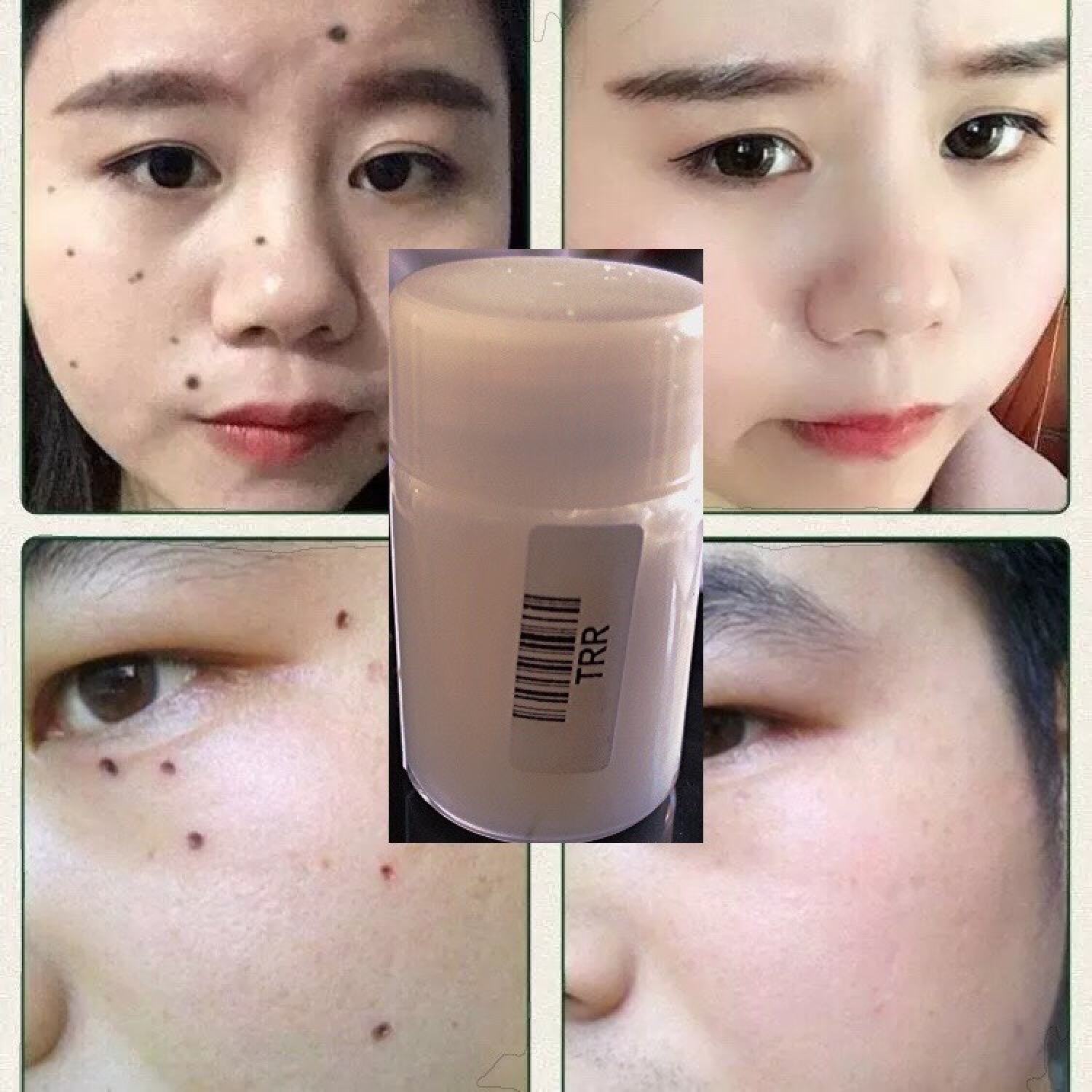 Tẩy nốt ruồi (🎁Tặng+ Freeship💝) Kem xóa Եàn nhang mụn thịt hiệu quá nhanh chóng