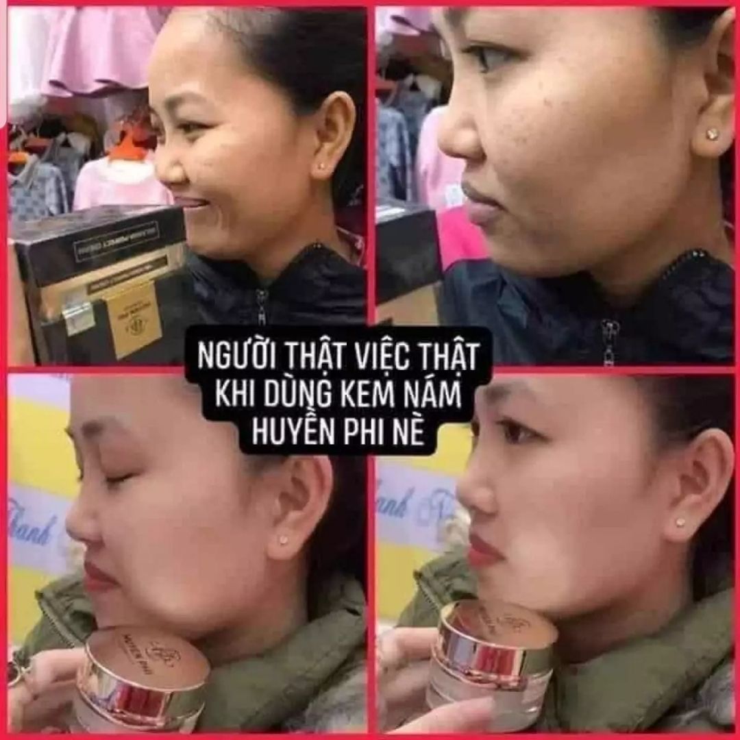 [HCM]KEM NÁM HUYỀN PHI KEM T.RI NÁM Công dụng thấm sâu bên trong chân nám từ từ đẩy từ trong ra ngoài