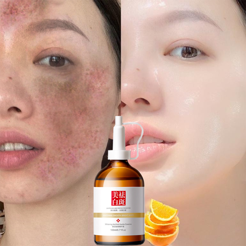 Serum dưỡng trắng xóa nám kem dưỡng trắng da mờ nám tàn nhang tinh chất xóa nám tàn nhang serum xóa nám tàn nhang trắng da 100ml làm mờ các loại nám nhanh chóng dưỡng trắng dưỡng ẩm da
