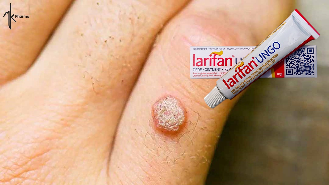 [HCM]TẨY MỤN CÓC VỚI KEM BÔI LARIFAN UNGO TỪ CHÂU ÂU – KHÔNG MỌC LẠI