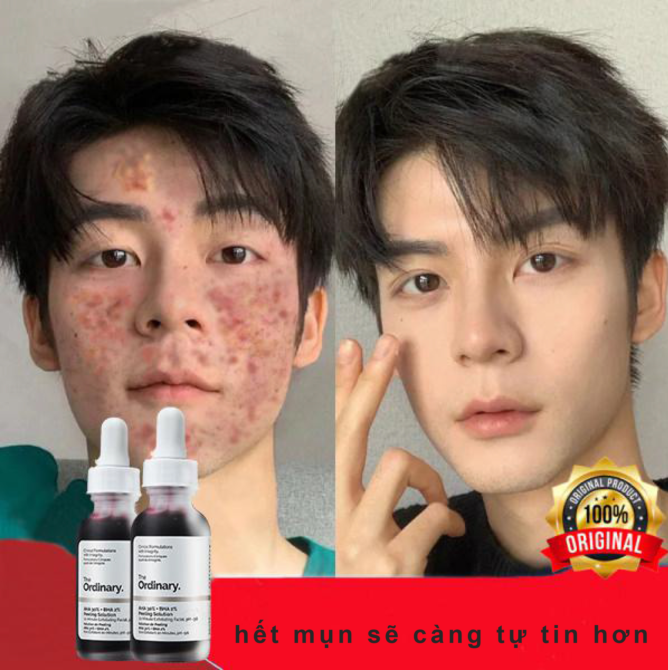 Loại bỏ mụn trứng cá, Serum The Ordinary AHA 30% + BHA 2% Peeling Solution,Có hiệu quả nhanh chóng đối với các vết thâm do mụn trứng cá gây ra- chứa Tinh chất dưỡng trắng da