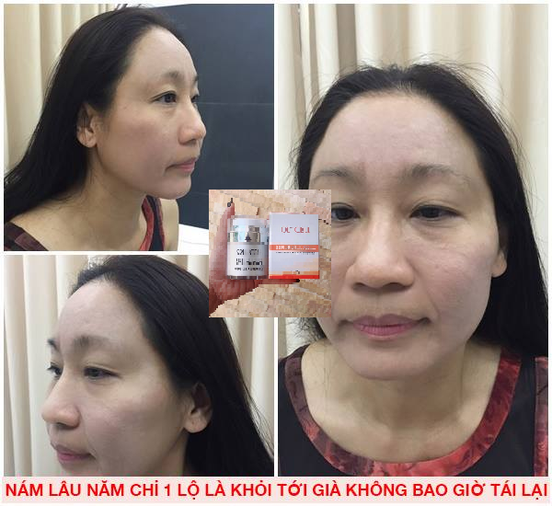 Olcell hút nám tặng kem trắng da mặt 22Again