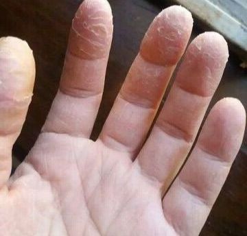 Bôi Thả.o Dượ.C QUÝ đánh bay Á sừng, Chàm khô bong da đầu ngón tay ngón chân, lòng bàn tay, bàn chân kem Cải thiện chăm sóc Da liễu