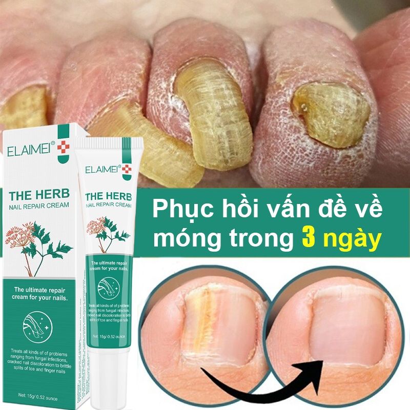 Tinh chất phục hồi móng kem loại bỏ nấm móng Kem phục hồi móng nấm móng viêm mé chân loại bỏ nấm móng gãy móng chống các bệnh nấm móng kháng khuẩn 20g Loại bỏ nấm móng gãy, quyết vấn đề viêm mé dùng cho móng chân