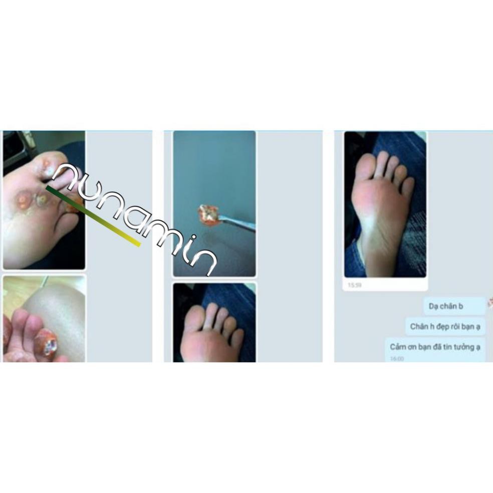 Chuyên dùng cho Mụn Cóc Mụn Cơm Mụn Thịt...-Nunamin Warts & Corns 15ml dung dịch mụn cóc mụn cơm mụn thịt