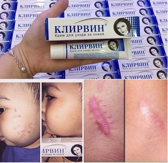 Chính hãng Klirvin ngăn ngừa sẹo, mụn, rạn da cao cấp 25g của Nga