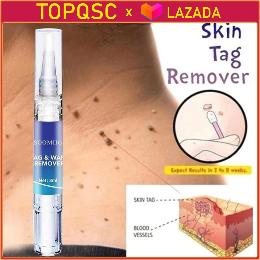Điều trị mụn cóc bẩm sinh dạng lỏng 3ml, loại bỏ mụn cóc mụn cóc loại bỏ nốt ruồi