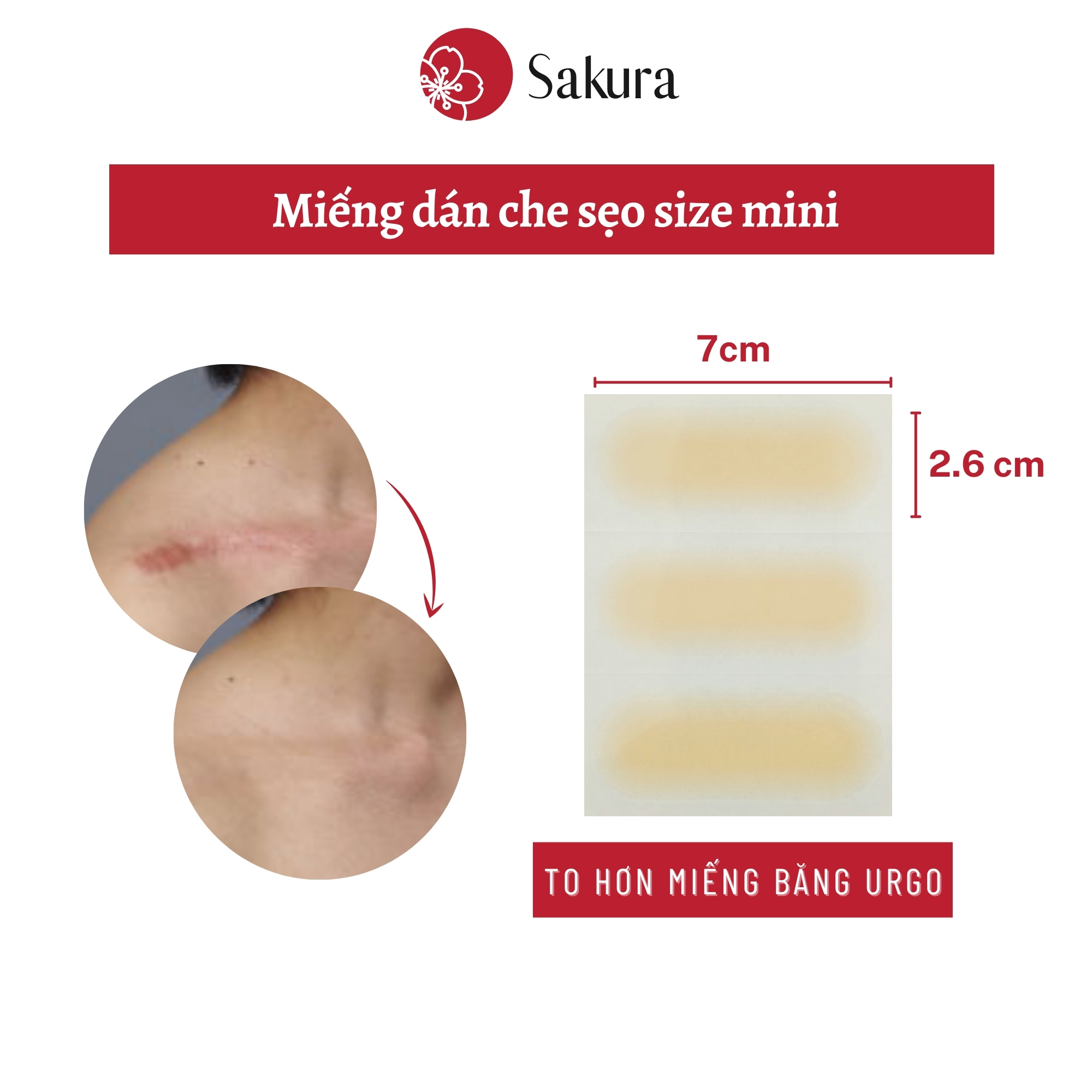 Miếng dán che sẹo Japan Sakura Urgo 2.6x7cm che khuyết điểm nhanh chóng chống mồ hôi, an toàn cho da, dễ dàng lựa chọn với nhiều màu da