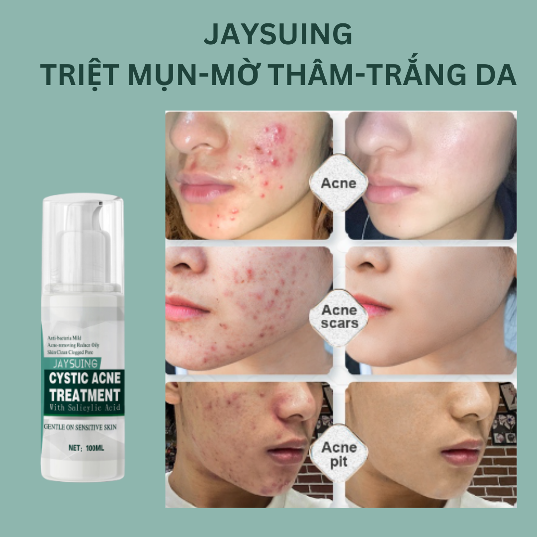   Hoàn Tiền 15%   Loại bỏ mụn nhanh trong 7 ngày  Kem Chấm Mụn Cấp Tốc Jaysuing Đánh Bay Các Loại Mụn Cám Mụn Bọc Mụn Ẩn Và Tàn Nhang Sẹo Thâm Se Khít Lỗ Chân Lông Hiệu Quả Nhanh Chóng 