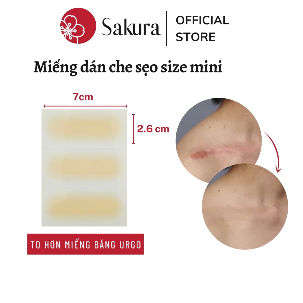 Miếng dán che sẹo Nhật Bản Sakura cỡ Urgo 2.6x7cm che sẹo lồi, sẹo lõm, sẹo phẫu thuật 3-5 ngày, chống nước, an toàn cho da