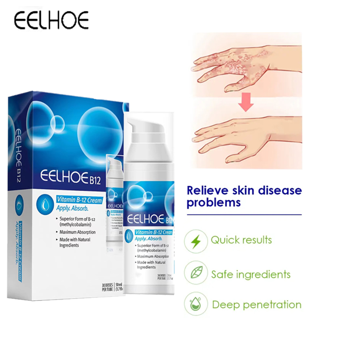 Kem bôi vảy nến VitaminB-12 thảo dược Psoriasis Ontment Herbal kem bôi Viêm Da Cơ Địa, Kem Bôi Da Liễu Ngoài Da