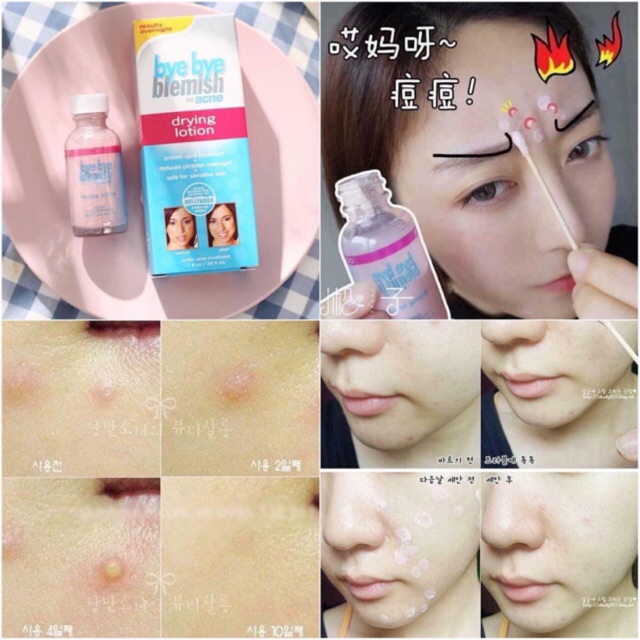 ?dung dịch chấm giảm mụn bye bye blemish?