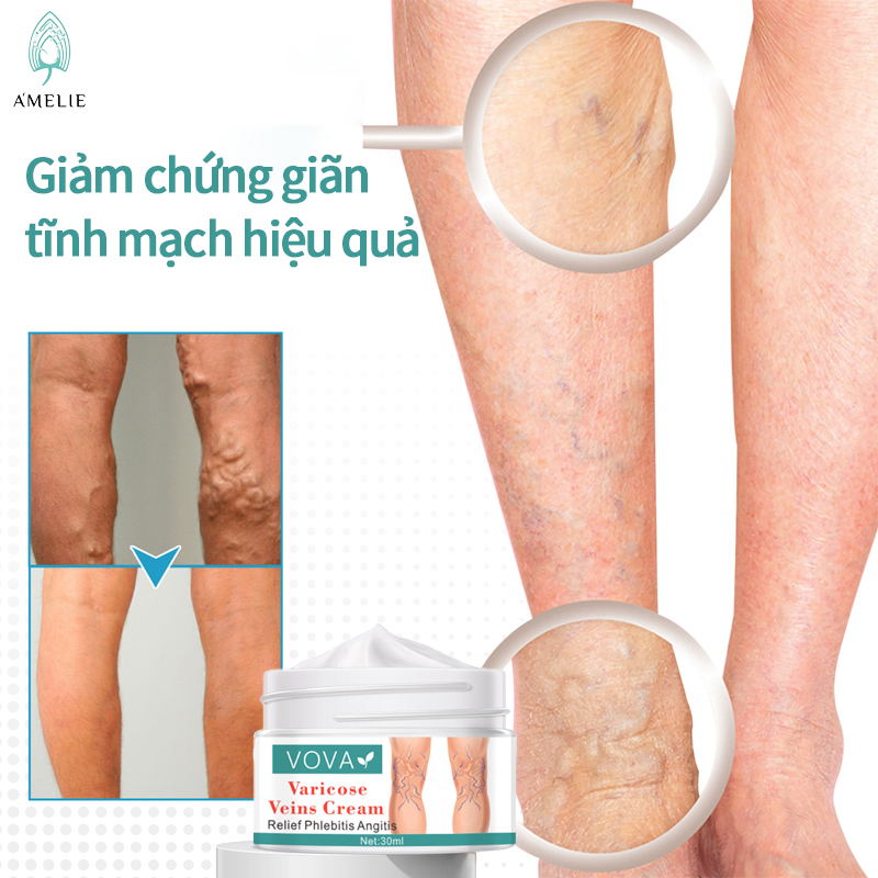 Kem Giảm Suy Giãn Tĩnh Mạch VOVA Giảm Suy Giãn tĩnh mạch, tĩnh mạch nhện, viêm, khô, tuần hoàn kém 30ml