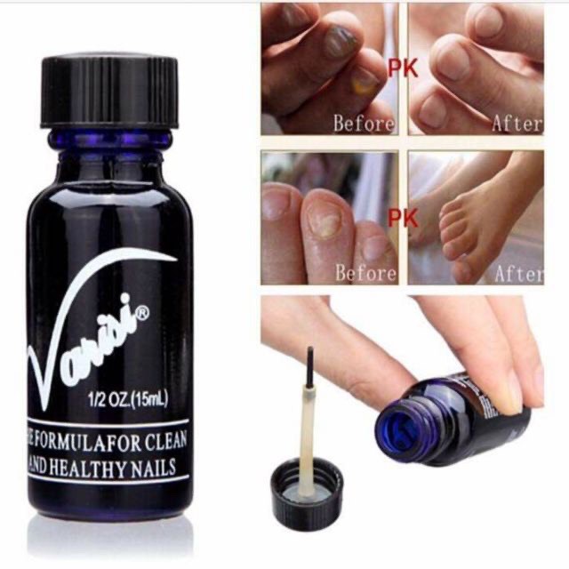 Nấm móng varisi , giúp loại bỏ nấm móng tay, nấm móng chân