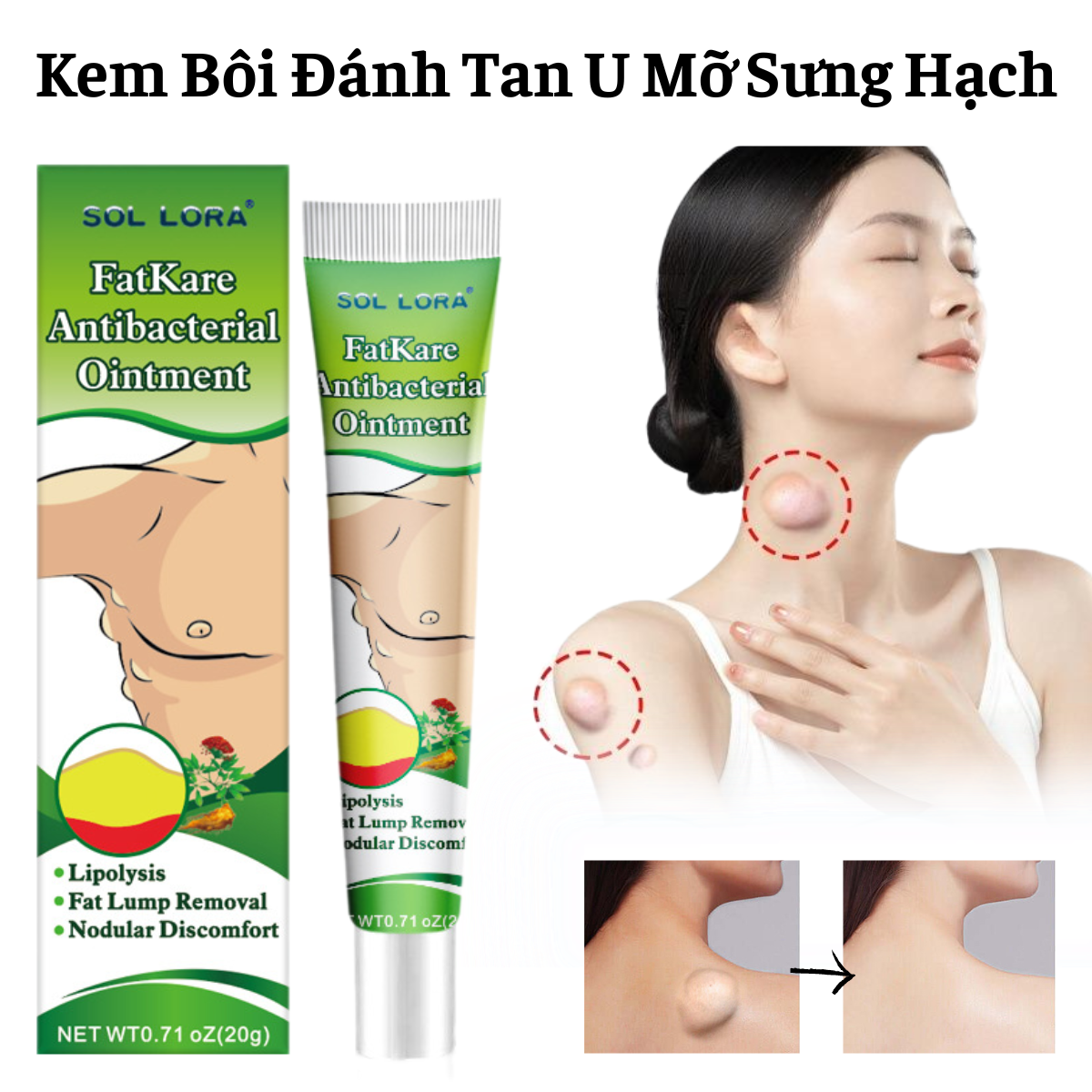 Kem Thảo Dược Đánh Tan U Mỡ Sưng Hạch Trên Toàn Cơ Thể Xẹp Nhanh Hiệu Quả Không Để Lại Sẹo 20G