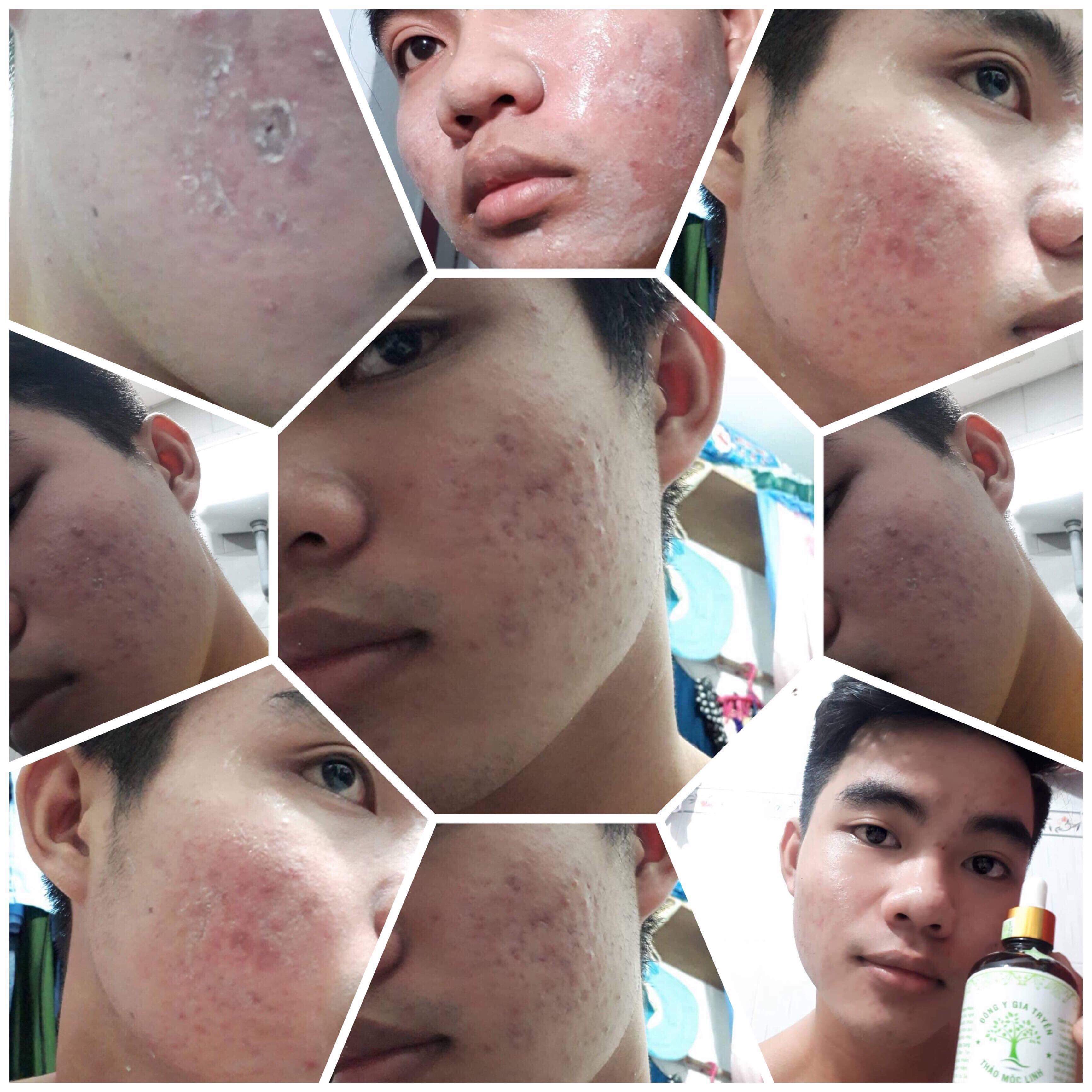 Đông y gia truyền Thảo Mộc Linh ngừa mụn, thải độc da, tái tạo và phục hồi làn da