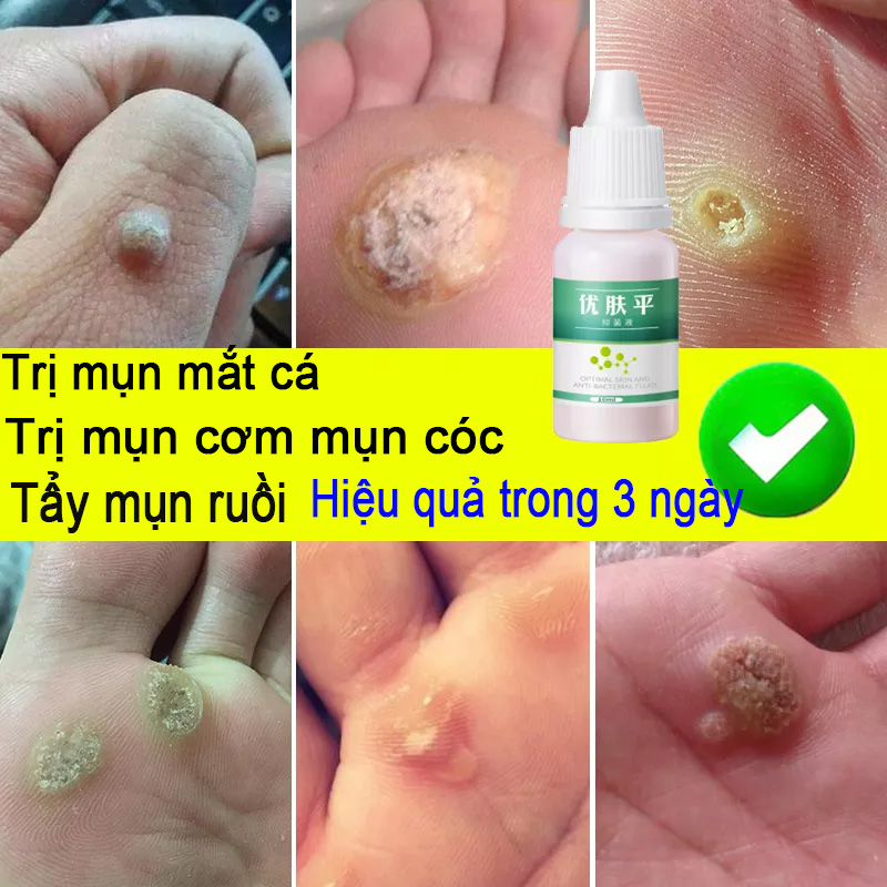 Mụn cơm Mụn cóc Mụn mắt cá Tẩy nốt ruồi Tẩy mụn ruồi 10ML kem ngừa sẹo lồi thâm sẹo rỗ lâu năm các loại sẹo mụn miếng dán mụn cóc hột mụn cơm