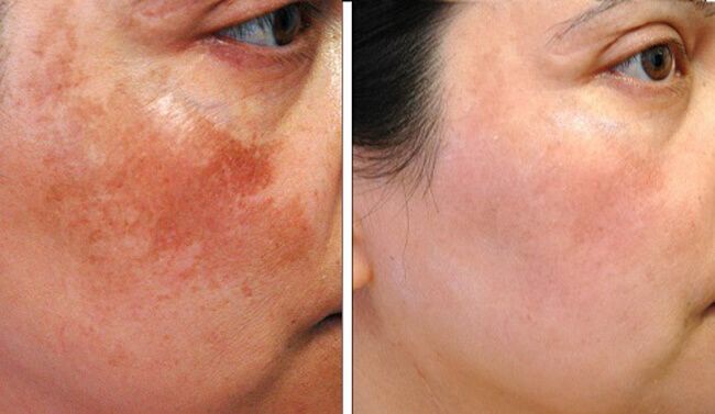 Kem cải thiện nám sáng dạ chuyên sau Achromin
